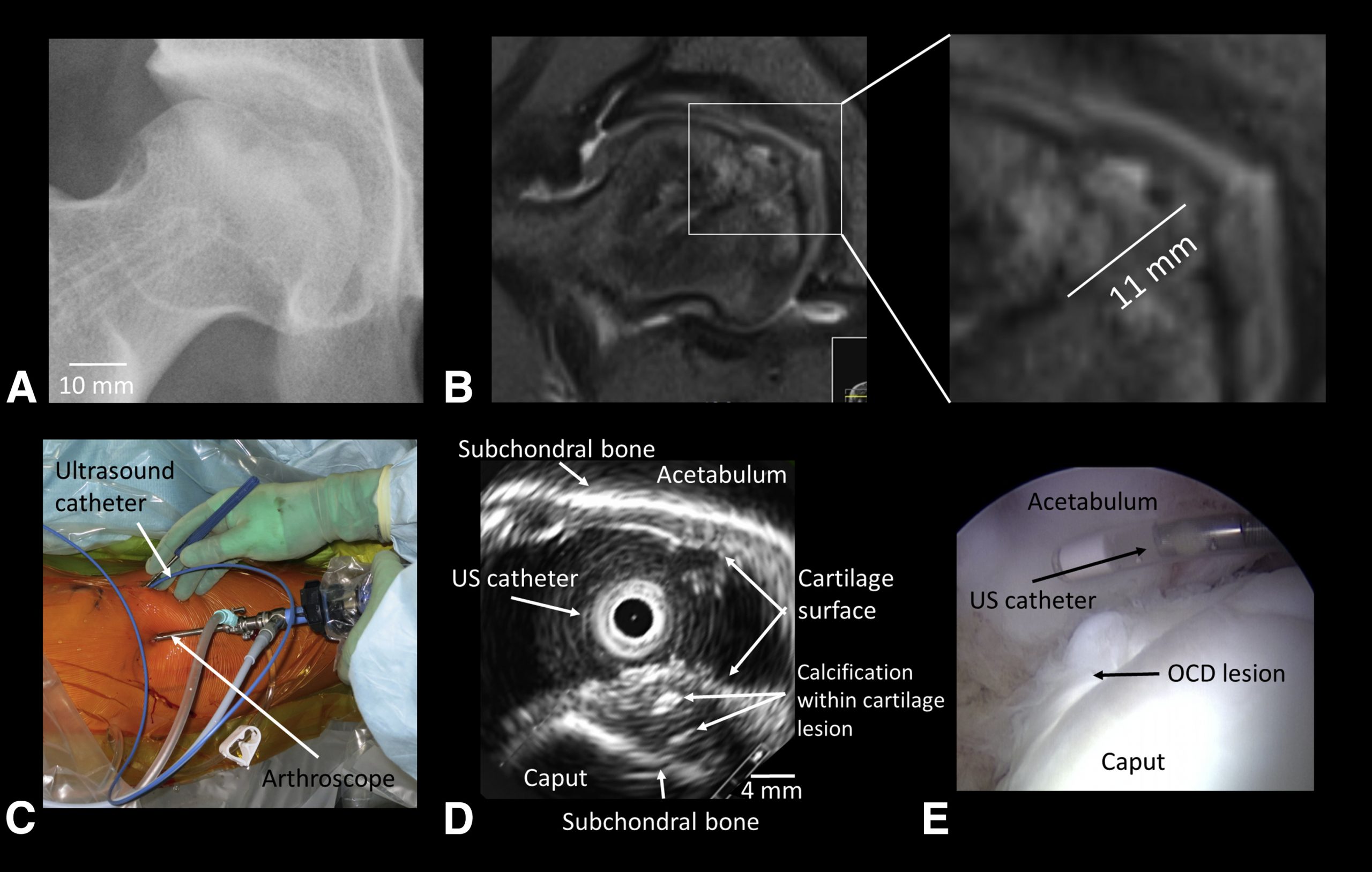 Ultrasound Arthroscopy of Hip in Treatment of Osteochondritis Dissecans